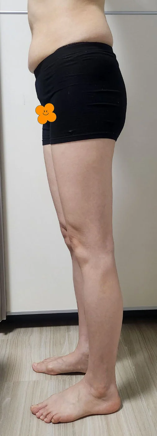 3 months after hip fat grafting - Hip Fat Grafting Before 2 - TheLINE Plastic Surgery