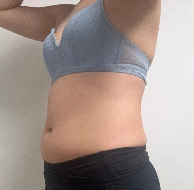 It's been 3 months since my abdominal li - Abdominal Liposuction (Upper Body) Before 2 - TheLINE Plastic Surgery
