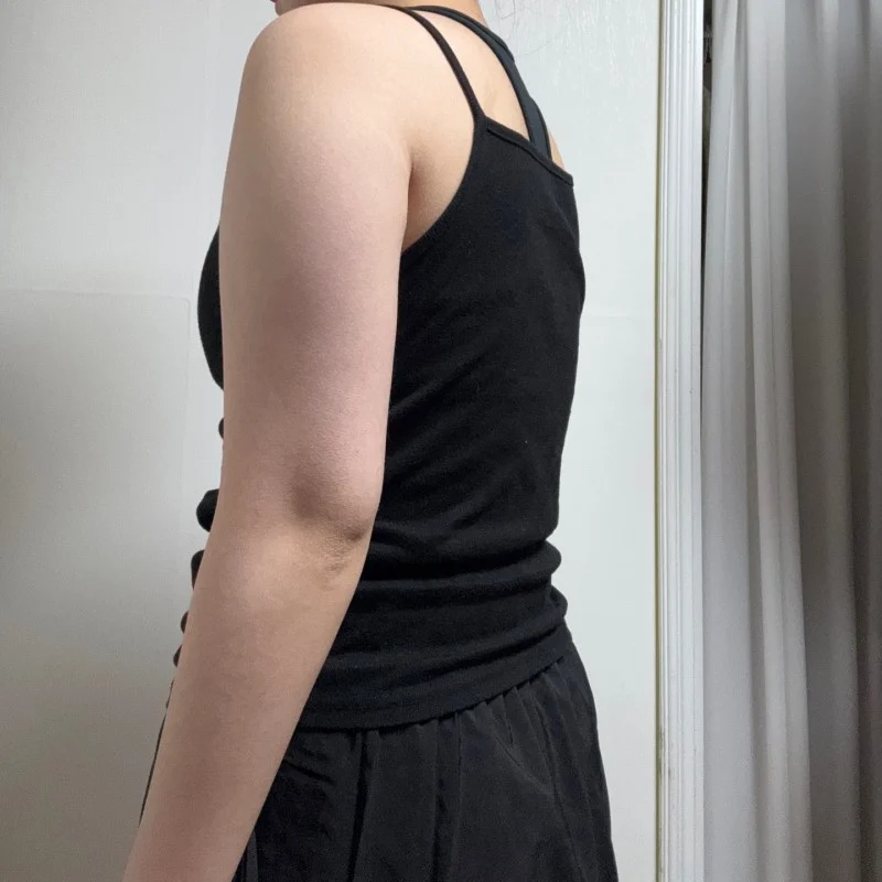 3 months after arm liposuction! - Arm Liposuction Before 2 - TheLINE Plastic Surgery