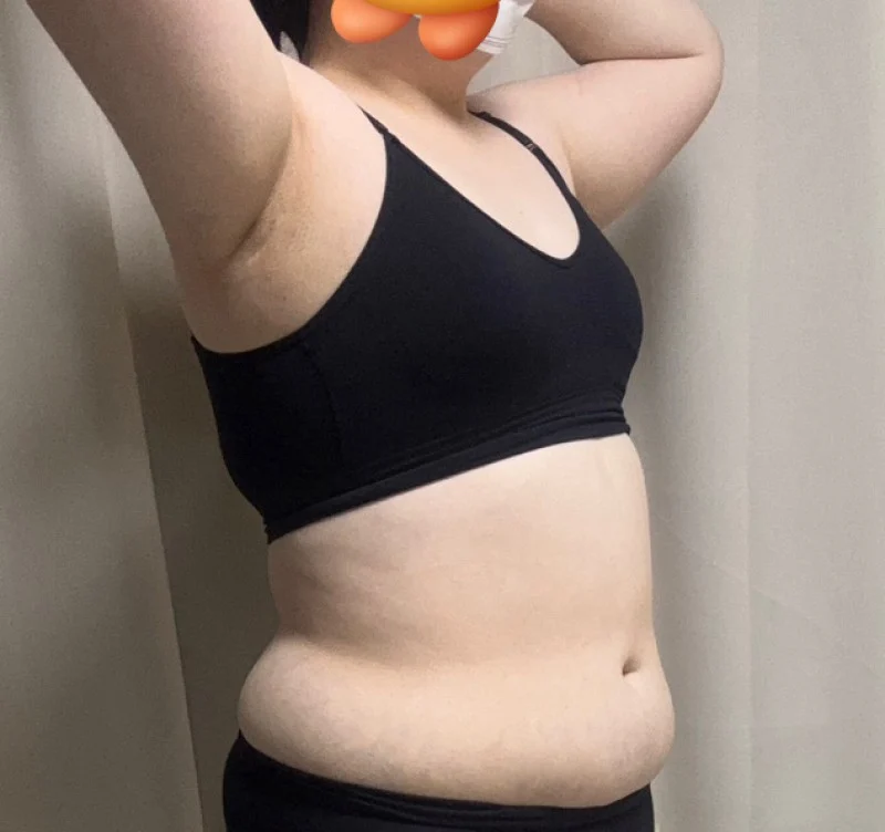 3 months after upper body liposuction - Abdominal Liposuction (Upper Body) Before 2 - TheLINE Plastic Surgery