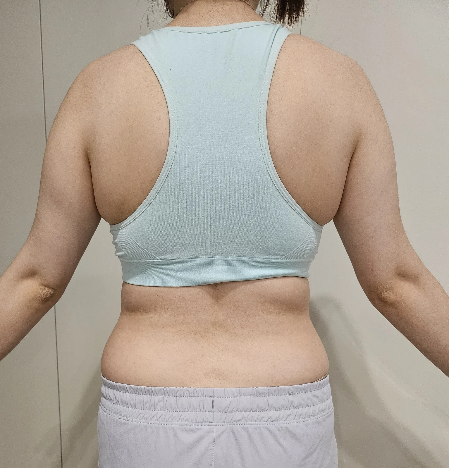 2-month update - Arm Liposuction Before 2 - TheLINE Plastic Surgery