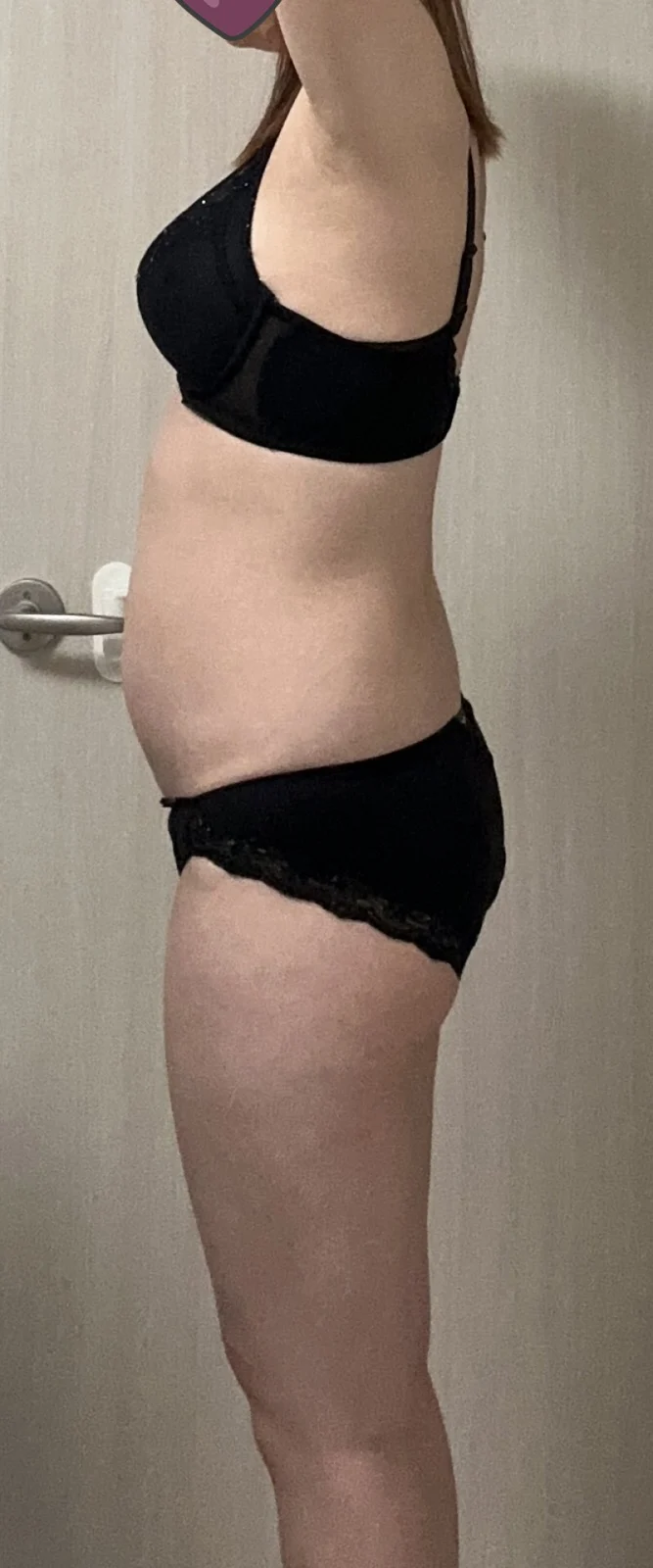 3 months after abdomen, thigh, arm and C - Hip Fat Grafting Before 2 - TheLINE Plastic Surgery