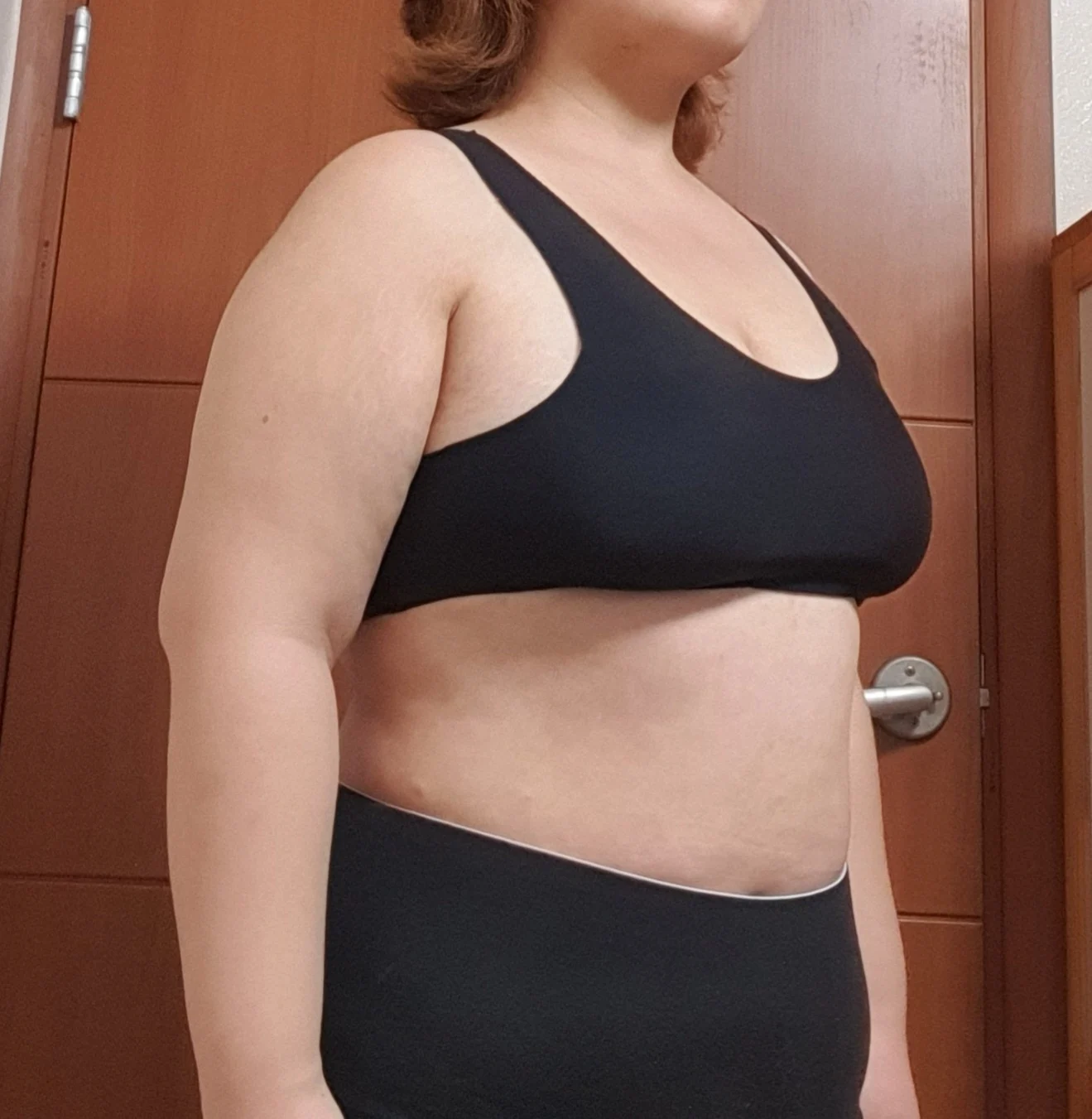 6-month review of arms + accessory breas - Arm Liposuction Before 2 - TheLINE Plastic Surgery