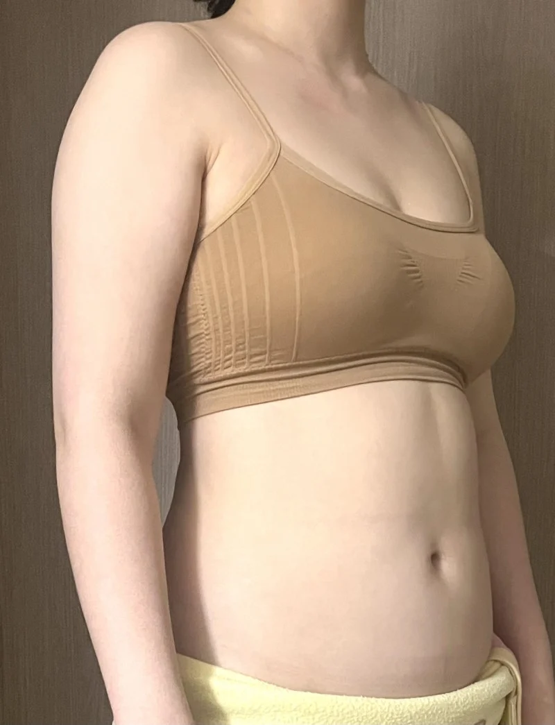 6-month review of full abdomen + arms - Arm Liposuction Before 2 - TheLINE Plastic Surgery