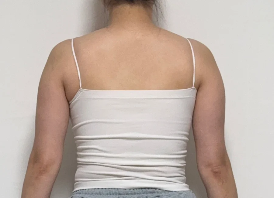 Sharing my 3-month upper arm + accessory - Arm Liposuction Before 2 - TheLINE Plastic Surgery