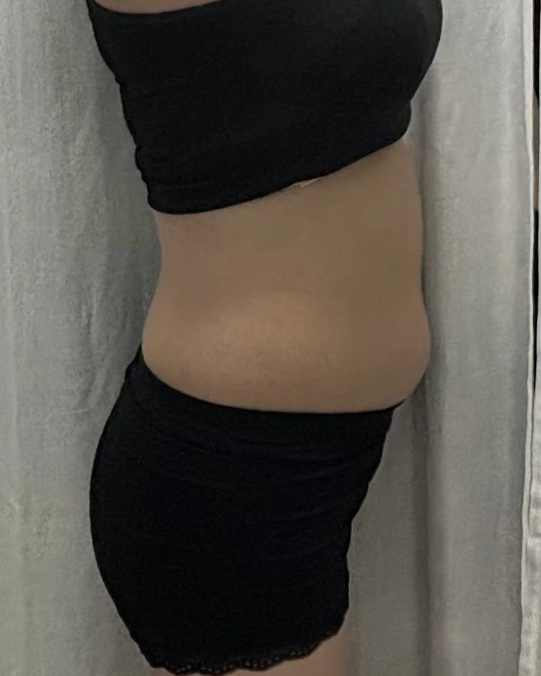 Abdominal lipo and hip dip grafting revi - Hip Fat Grafting Before 2 - TheLINE Plastic Surgery
