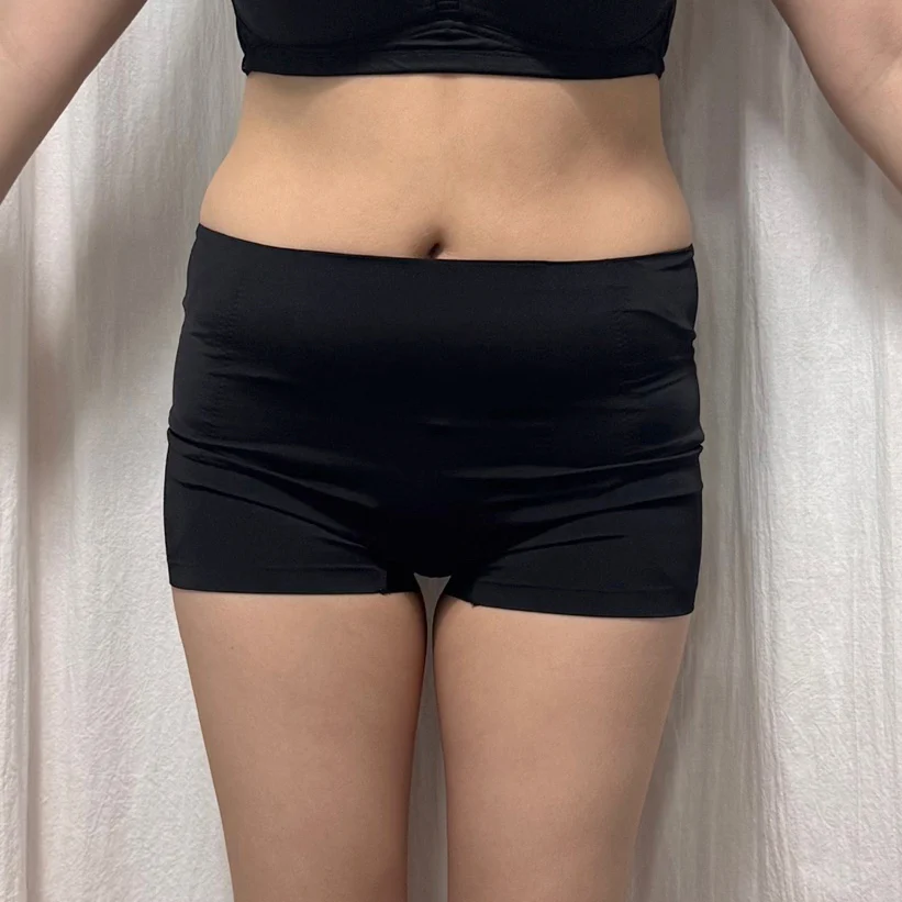 My waist-hip-saddlebag review - Hip Fat Grafting Before 2 - TheLINE Plastic Surgery