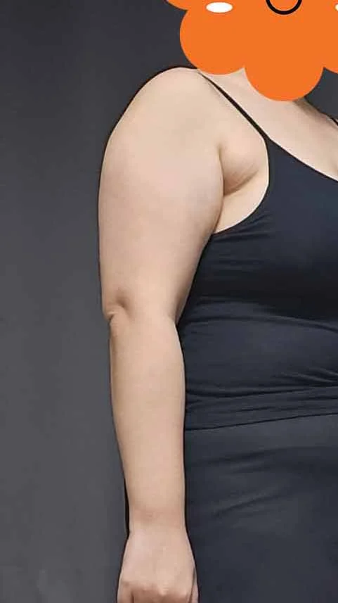 So happy with my arm liposuction hehe - Arm Liposuction Before 2 - TheLINE Plastic Surgery