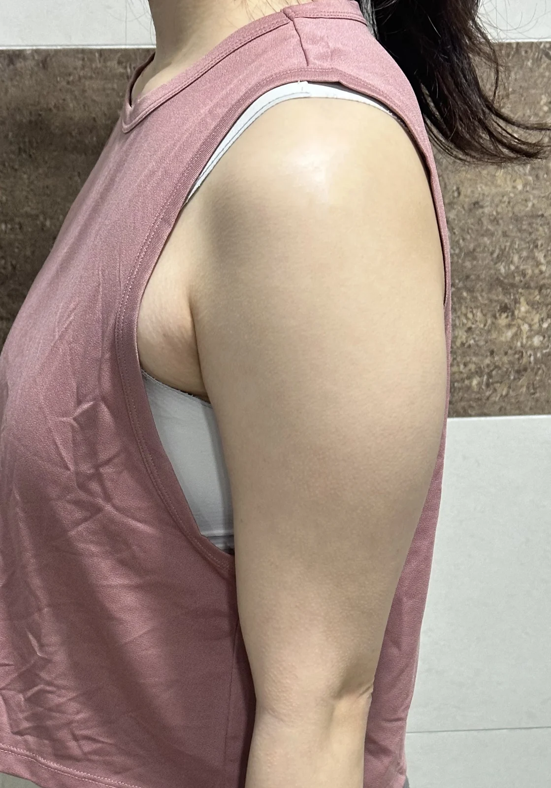Arm and accessory breast lipo review! - Arm Liposuction Before 2 - TheLINE Plastic Surgery