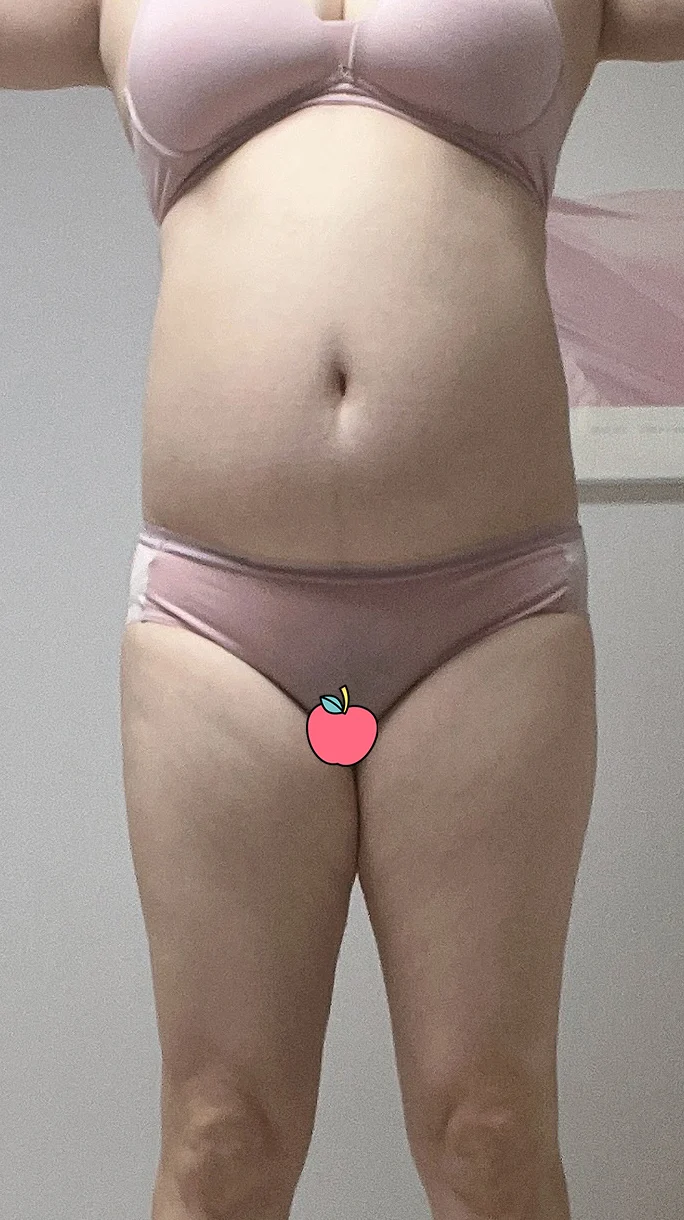 My proud 3-month review~ - Hip Fat Grafting Before 2 - TheLINE Plastic Surgery
