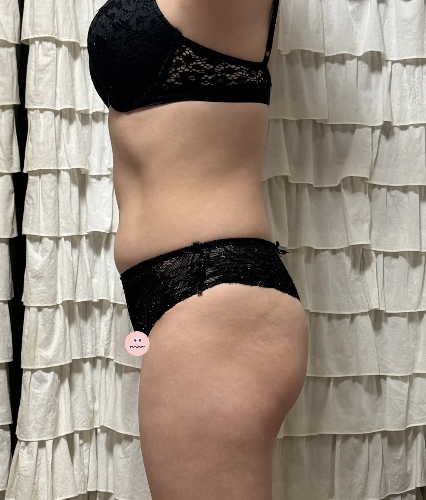My 3-month review - Other Liposuction Before 2 - TheLINE Plastic Surgery