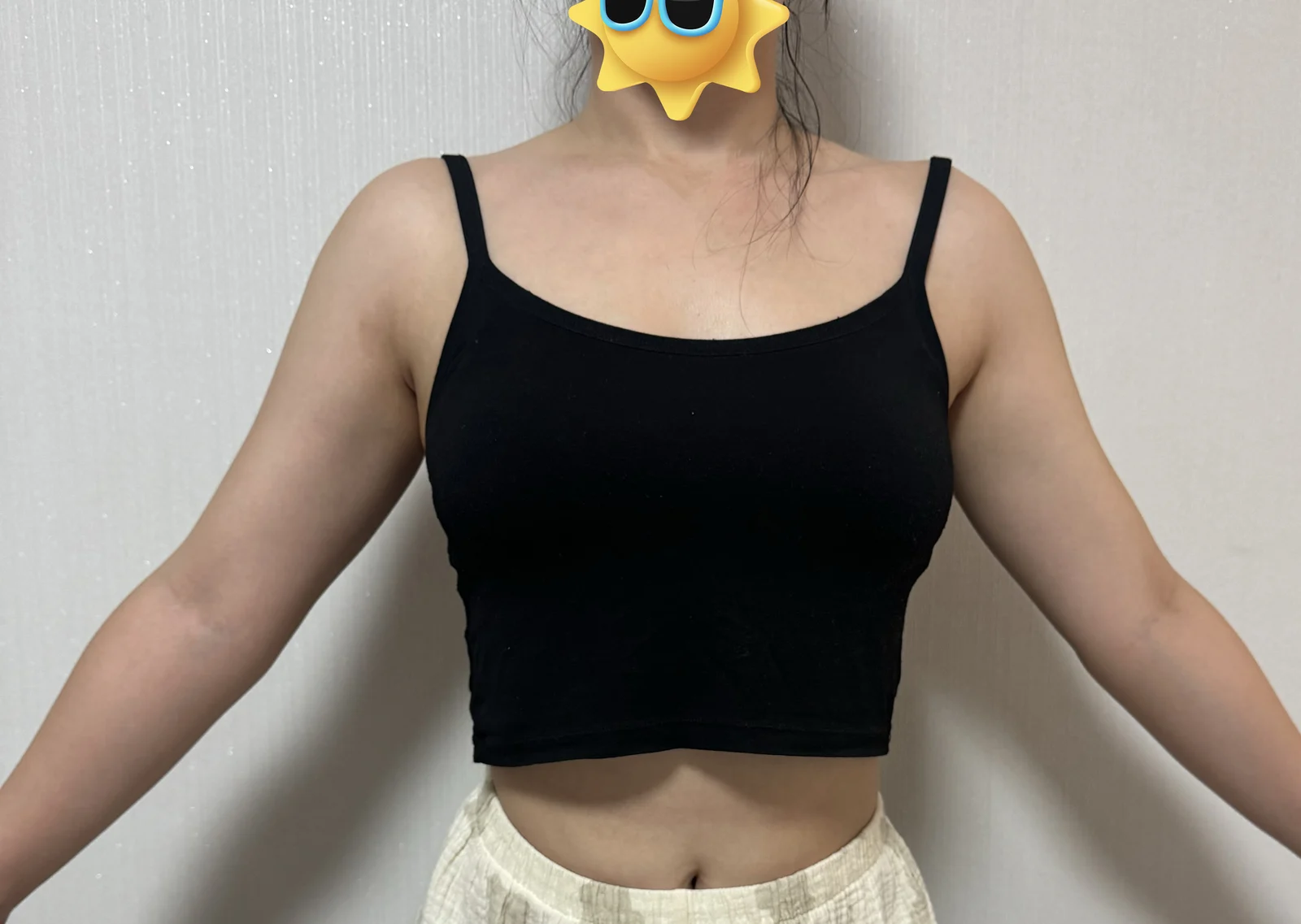 1-month review of arm + back root liposu - Arm Liposuction Before 2 - TheLINE Plastic Surgery