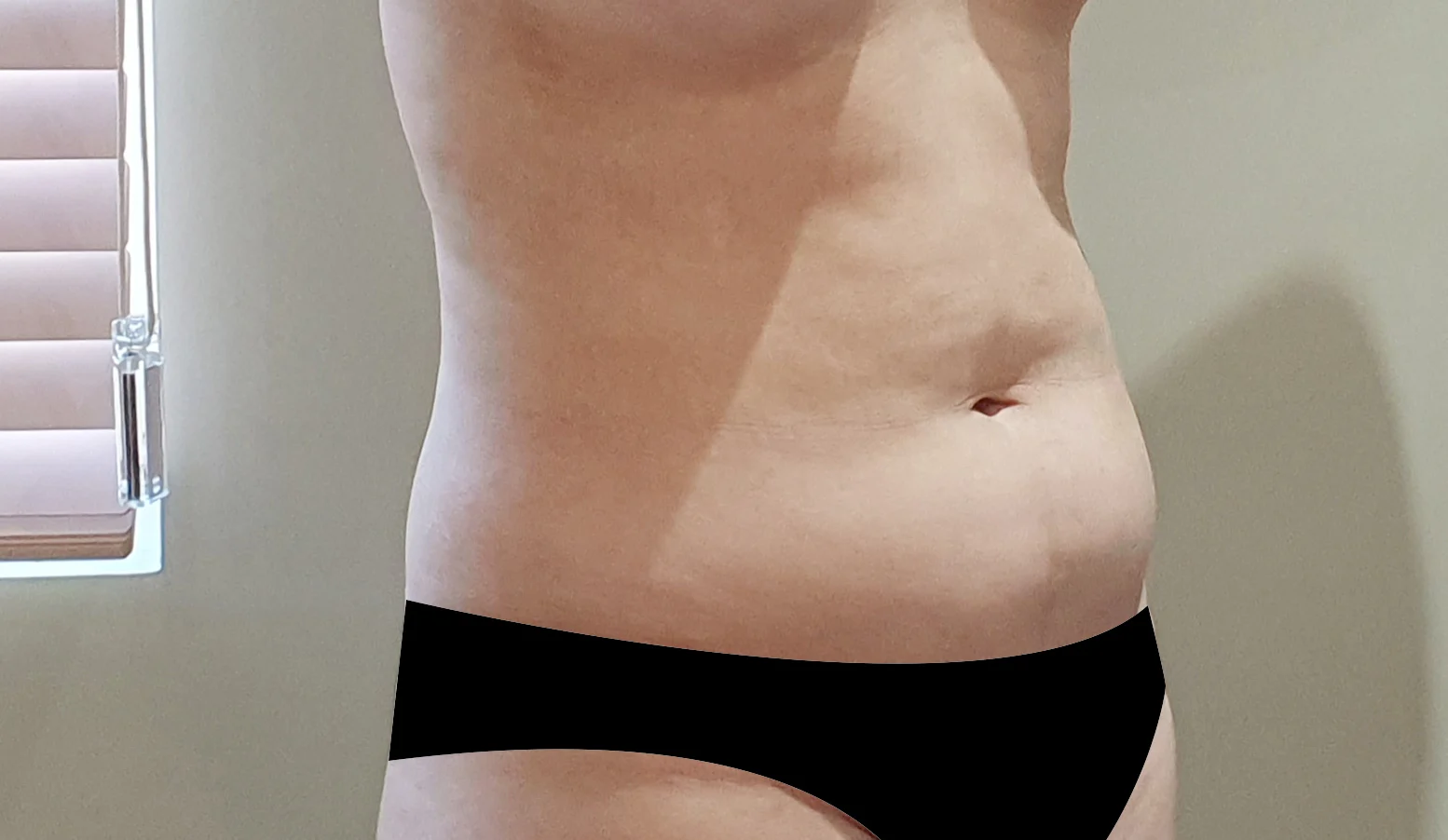 I am at 6 months after abdominal lipo! - Abdominal Liposuction (Upper Body) Before 2 - TheLINE Plastic Surgery