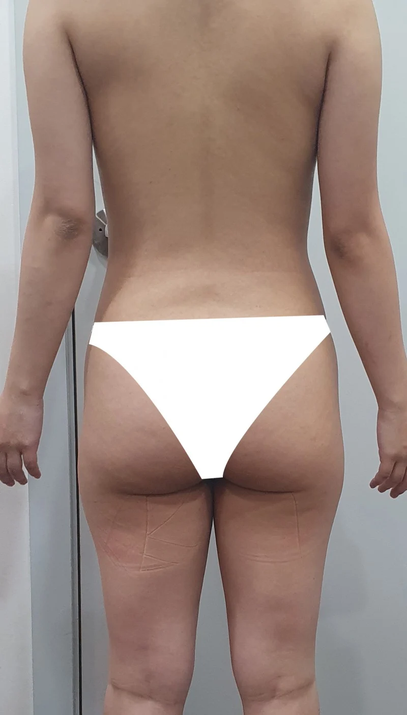 Thigh, abdomen and love handle lipo revi - Abdominal Liposuction (Upper Body) Before 2 - TheLINE Plastic Surgery