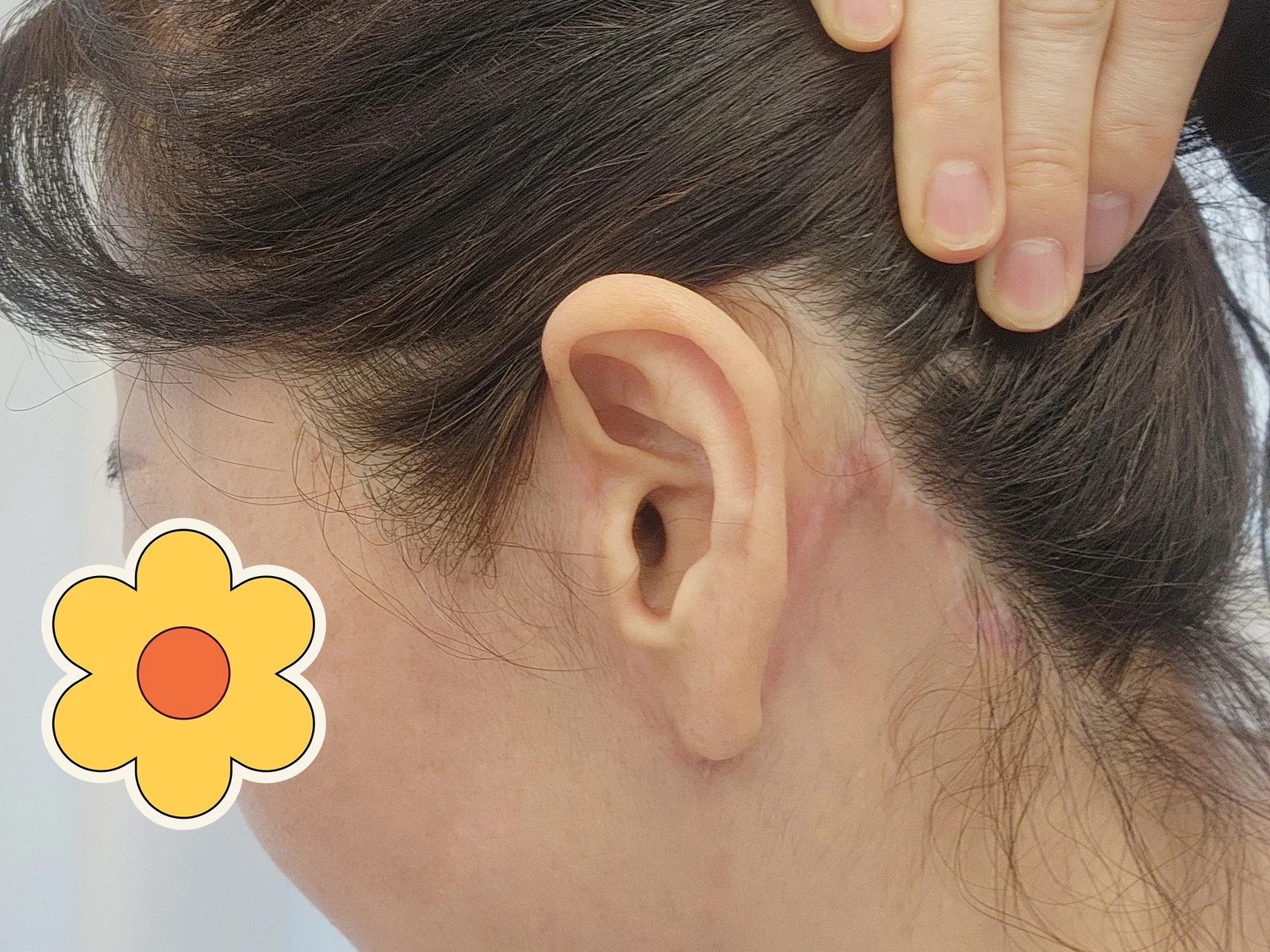 It has been 6 months since my facelift - Facial Liposuction After 3 - TheLINE Plastic Surgery