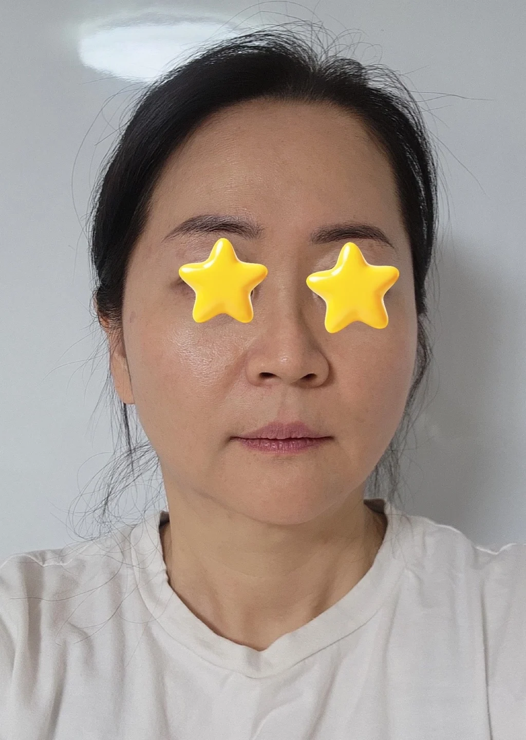 It has been 6 months since my facelift - Facial Liposuction surgery Before photo - TheLINE Plastic Surgery