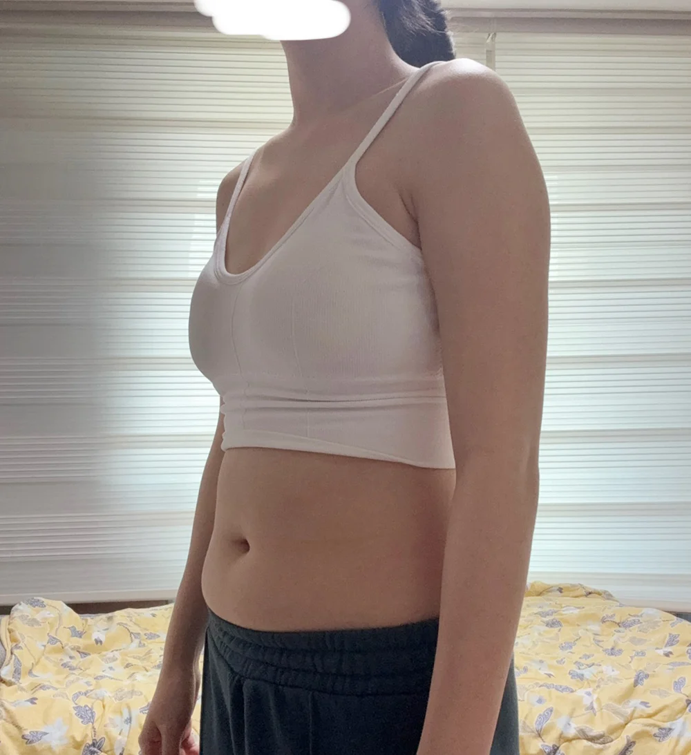 My review after doing arms, accessory br - Arm Liposuction Before 2 - TheLINE Plastic Surgery