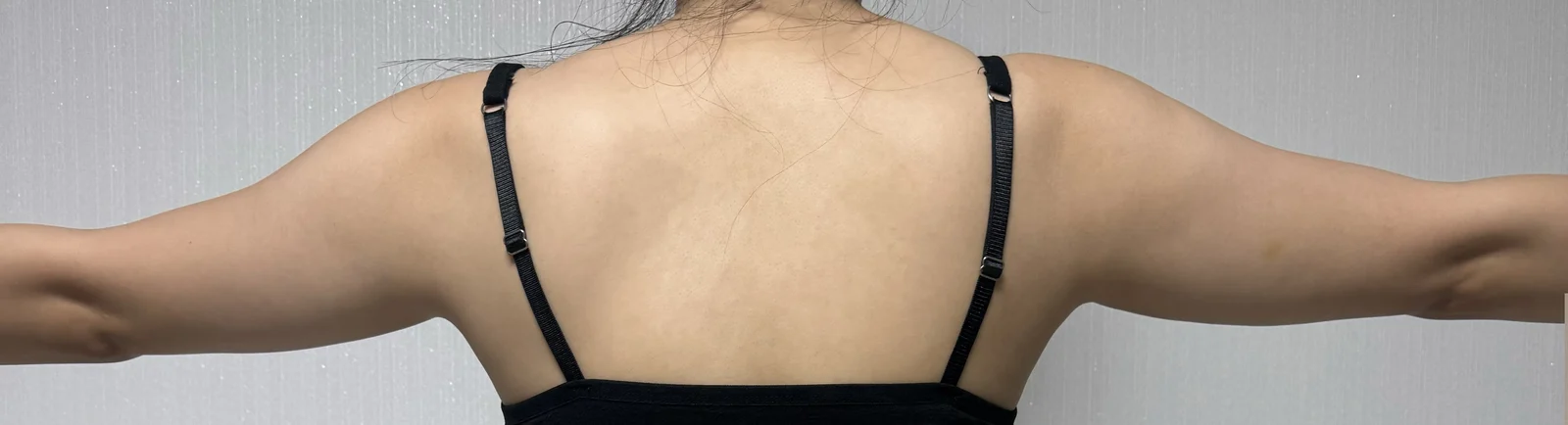 3 months after arm + back root liposucti - Arm Liposuction Before 2 - TheLINE Plastic Surgery