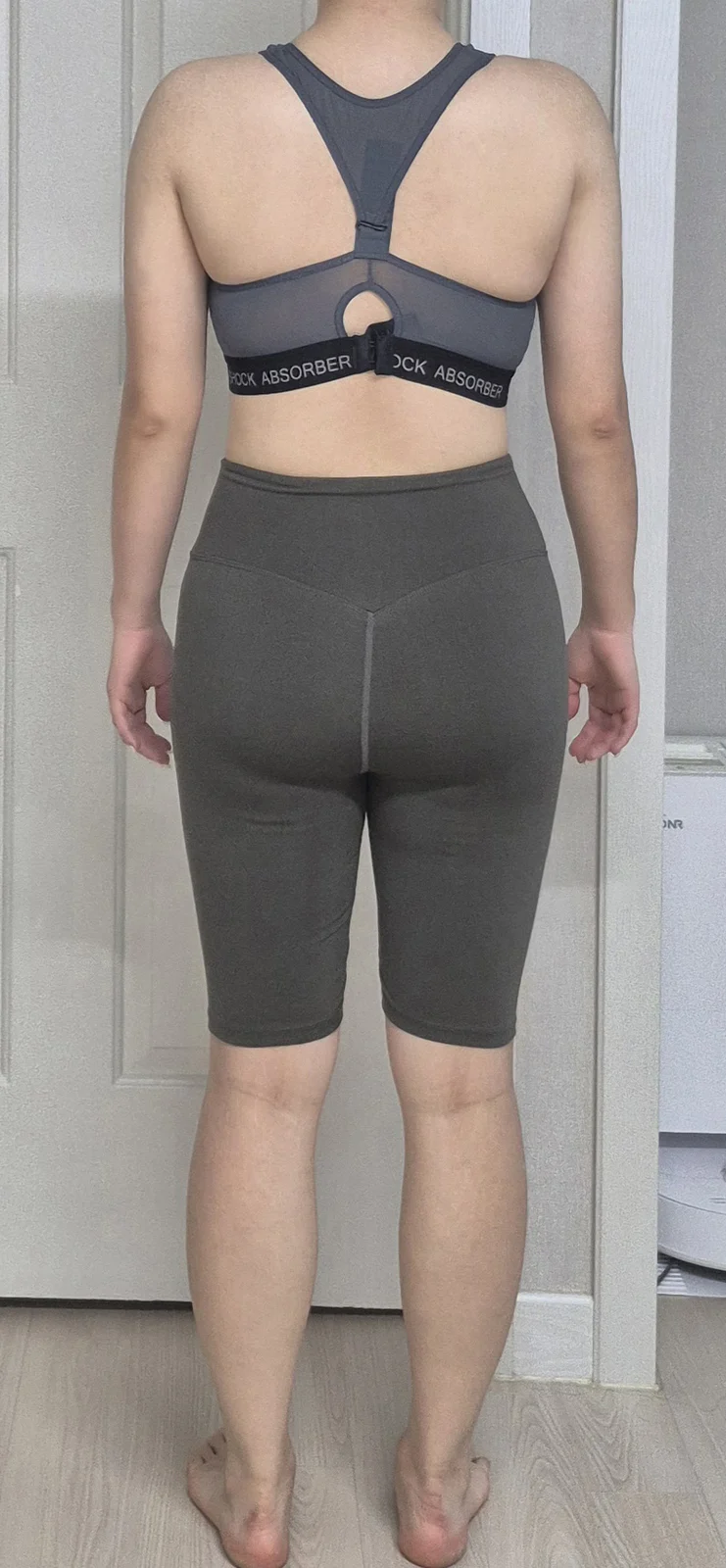 Full-body lipo & buttock (hip dip) graft - Hip Fat Grafting surgery After photo - TheLINE Plastic Surgery