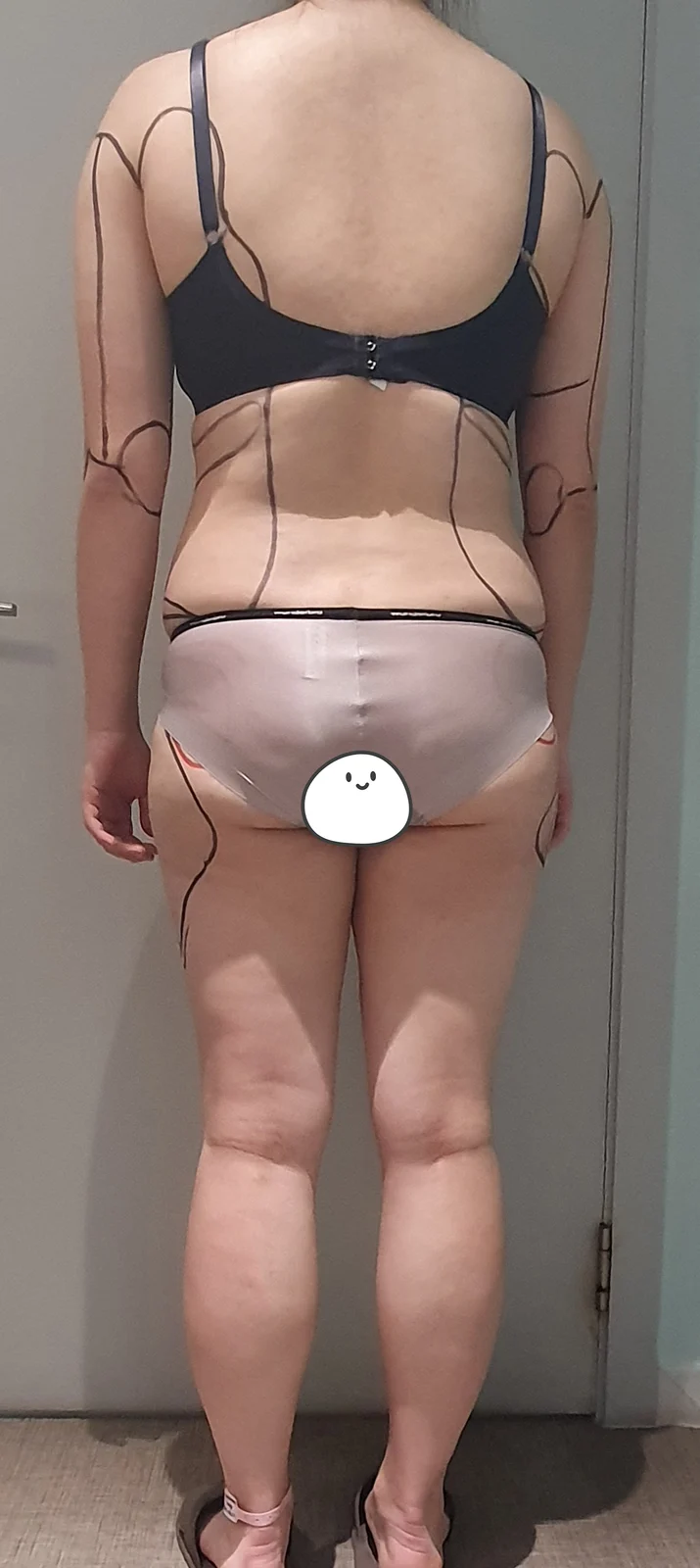 Full-body lipo & buttock (hip dip) graft - Hip Fat Grafting surgery Before photo - TheLINE Plastic Surgery