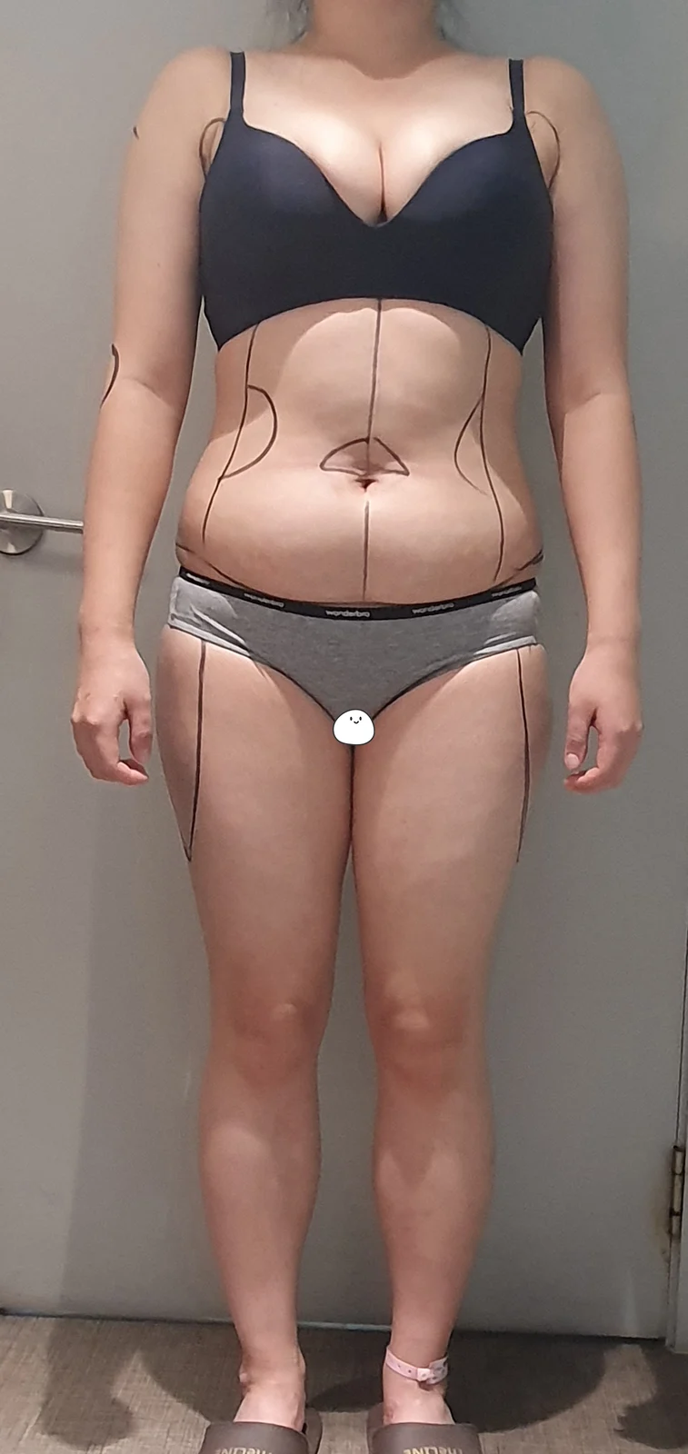 Full-body lipo & buttock (hip dip) graft - Hip Fat Grafting Before 2 - TheLINE Plastic Surgery