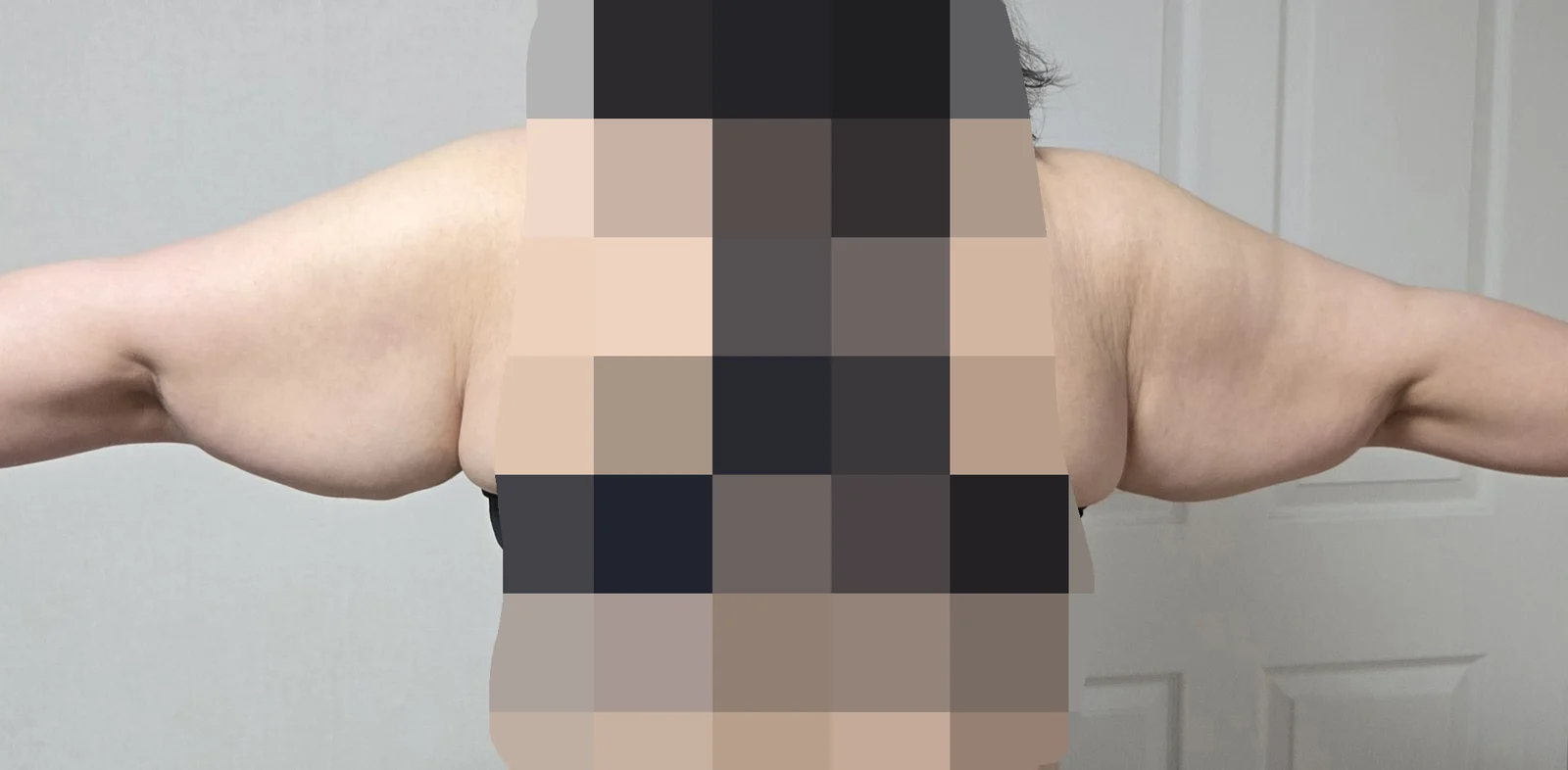 My self-esteem went up - Body Contouring Before 2 - TheLINE Plastic Surgery