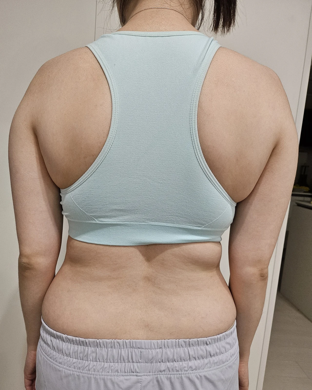 Abdomen and arm lipo, before and after - Arm Liposuction Before 2 - TheLINE Plastic Surgery