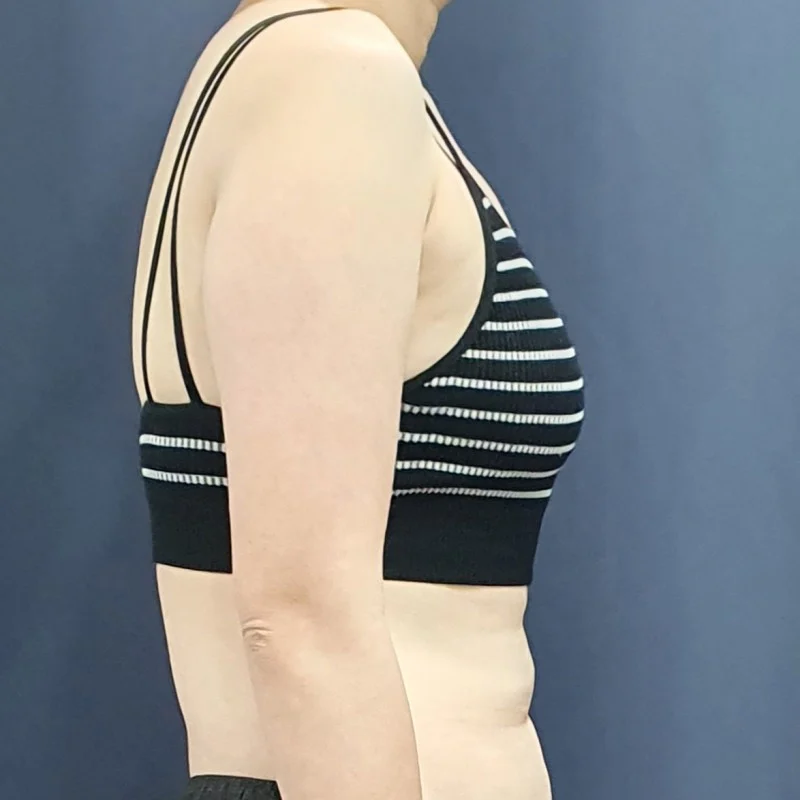 Posting my arm and accessory breast lipo - Arm Liposuction Before 2 - TheLINE Plastic Surgery