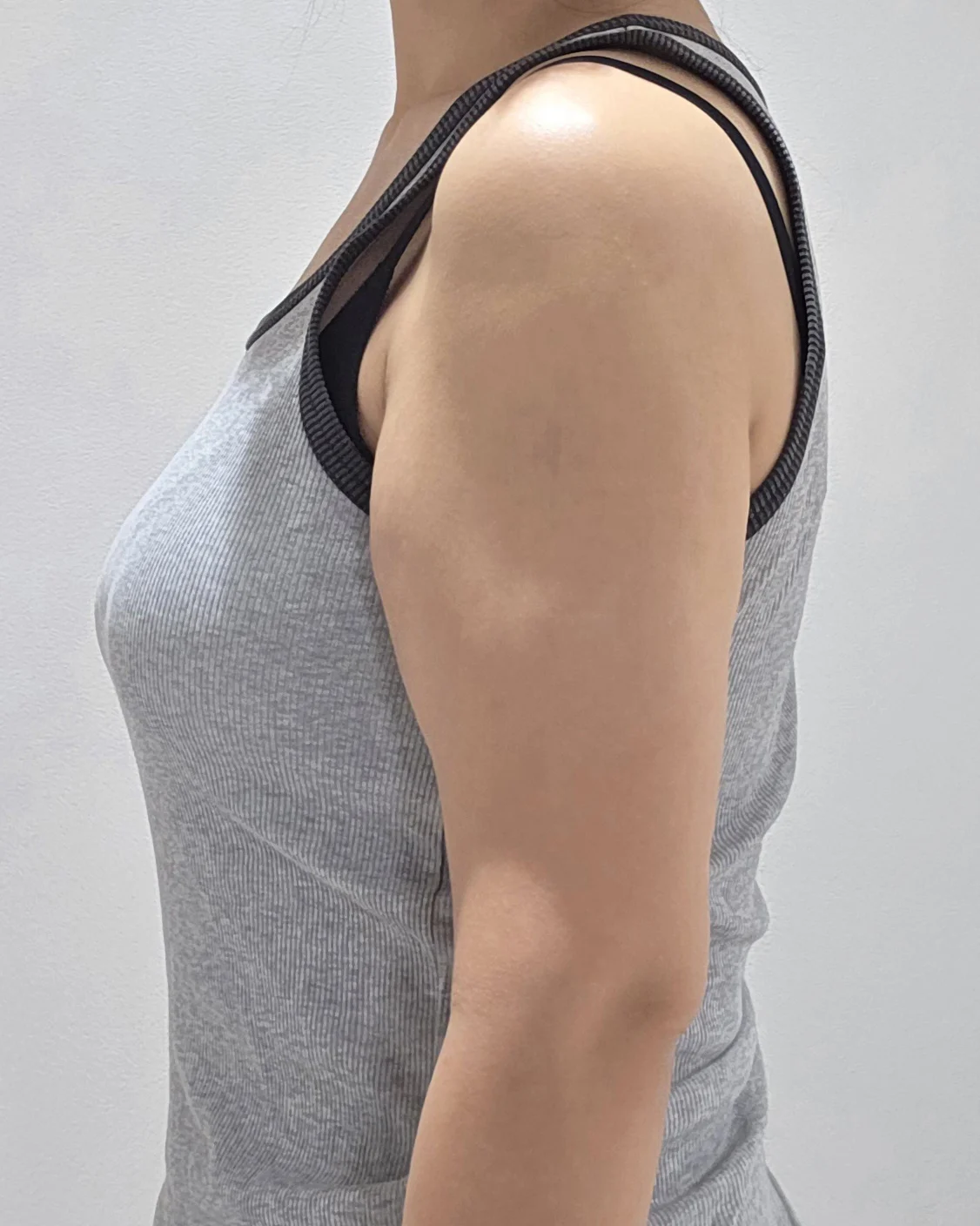 Three months after arm lipo and arm lift - Arm Liposuction Before 2 - TheLINE Plastic Surgery