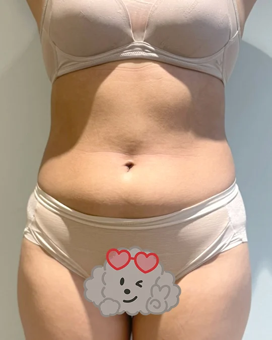 Abdominal lipo review with Dr. Yoongeun - Abdominal Liposuction (Upper Body) surgery Before photo - TheLINE Plastic Surgery