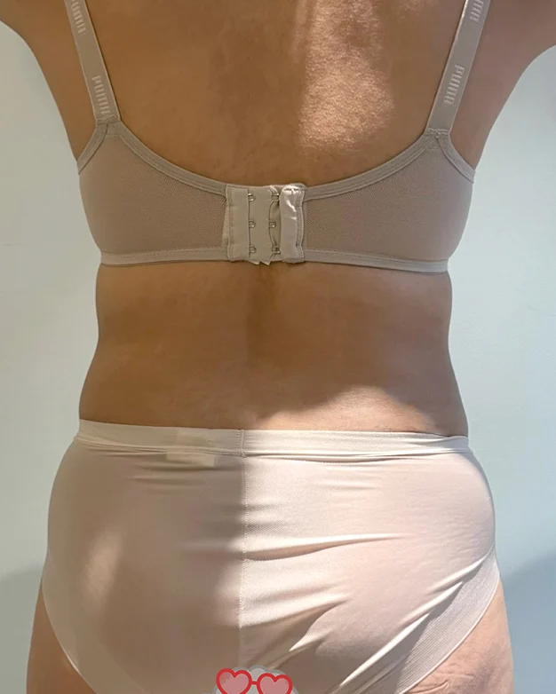 Abdominal lipo review with Dr. Yoongeun  - Abdominal Liposuction (Upper Body) Before 2 - TheLINE Plastic Surgery