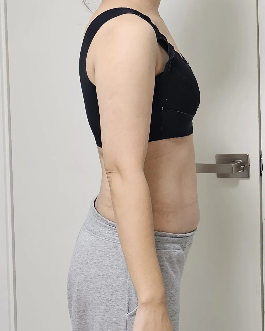 My arm and abdomen review~ - Arm Liposuction Before 2 - TheLINE Plastic Surgery