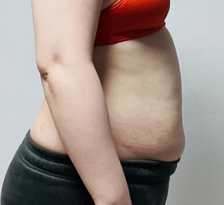 Three months after abdominal lipo - Abdominal Liposuction (Upper Body) Before 2 - TheLINE Plastic Surgery