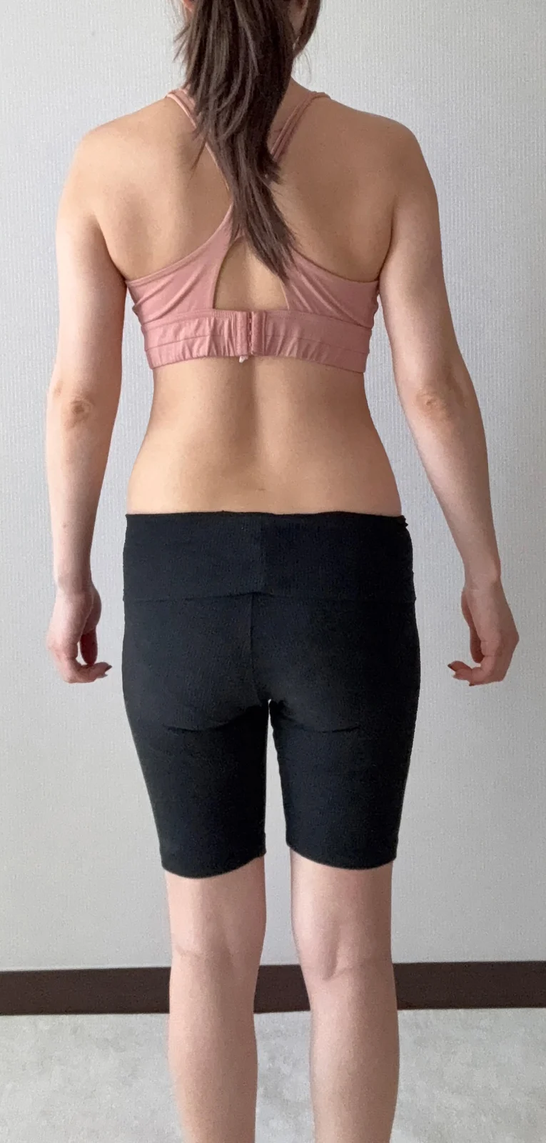 I had arm and abdominal lipo and grafted - Hip Fat Grafting Before 2 - TheLINE Plastic Surgery