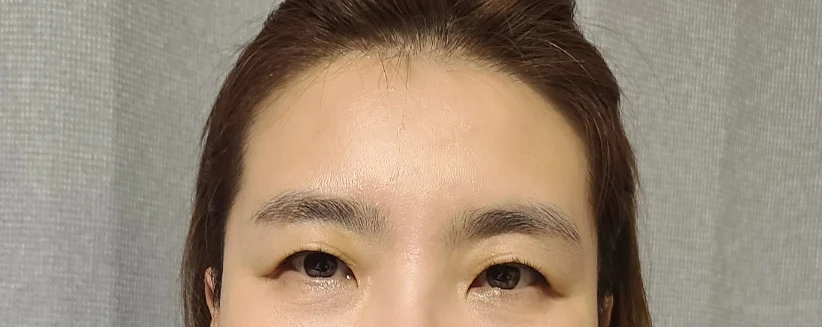 Forehead lift - Facial Liposuction Before 2 - TheLINE Plastic Surgery