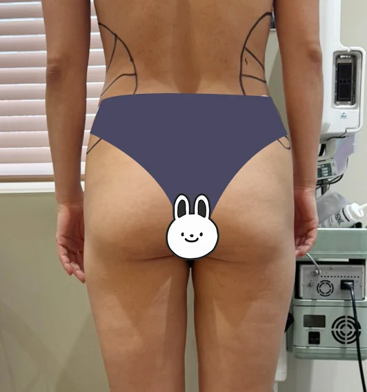 I am at 3 months after hip grafting~ - Abdominal Liposuction (Upper Body) Before 2 - TheLINE Plastic Surgery