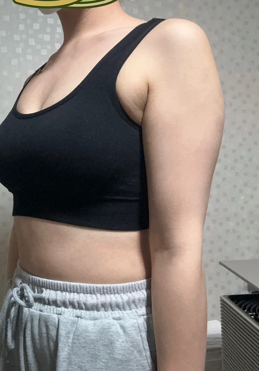 My 3-month arm review - Arm Liposuction Before 2 - TheLINE Plastic Surgery