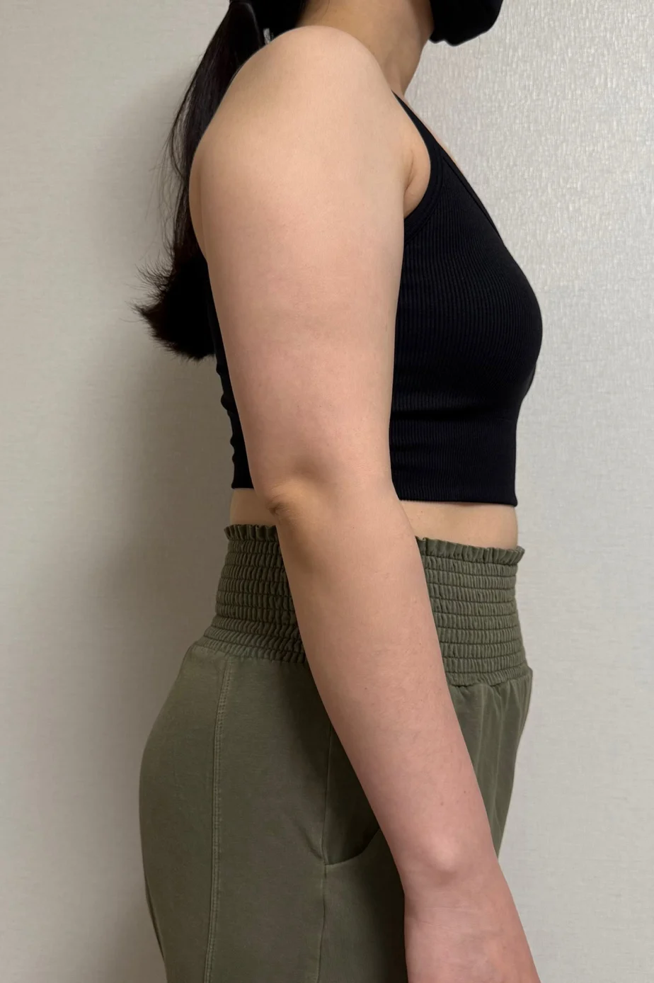 Arm lipo review! Really paying off this  - Arm Liposuction Before 2 - TheLINE Plastic Surgery