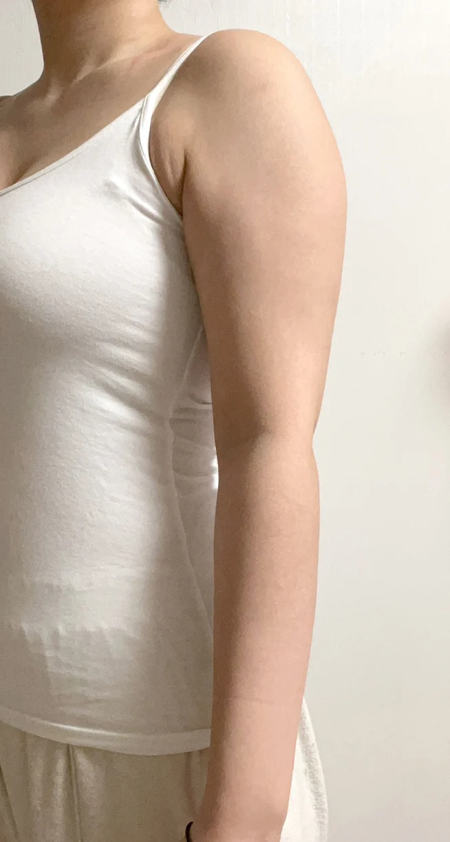 Upper arm liposuction, 6 months in! - Arm Liposuction Before 2 - TheLINE Plastic Surgery