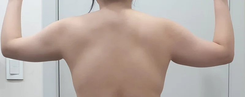 Upper arm liposuction, 6-month review - Arm Liposuction Before 2 - TheLINE Plastic Surgery