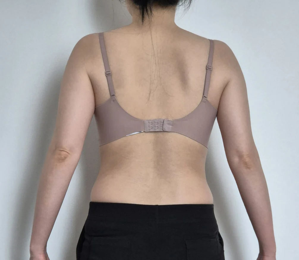 Stem cell arm liposuction, 3-month revie - Arm Liposuction Before 2 - TheLINE Plastic Surgery