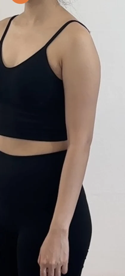 Arm liposuction, 3 months in - Arm Liposuction Before 2 - TheLINE Plastic Surgery