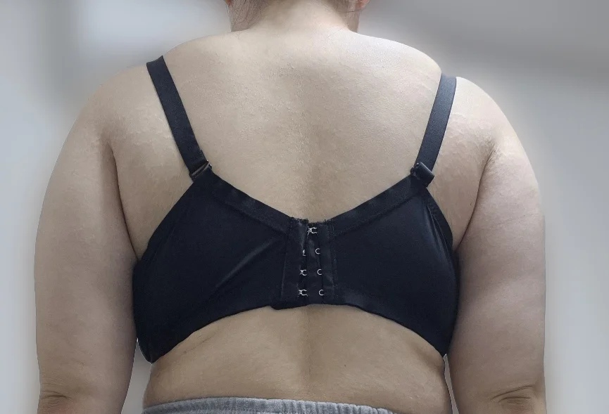 Arm liposuction, 3-month review - Arm Liposuction Before 2 - TheLINE Plastic Surgery