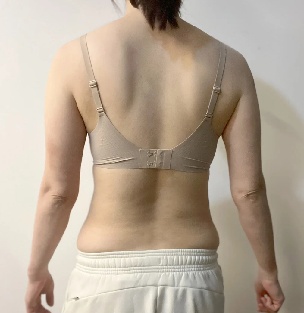 It has already been 6 months since my li - Breast Fat Grafting Before 2 - TheLINE Plastic Surgery