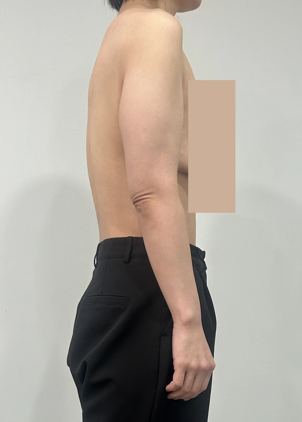 My arm lift surgery review~ - Body Contouring Before 2 - TheLINE Plastic Surgery