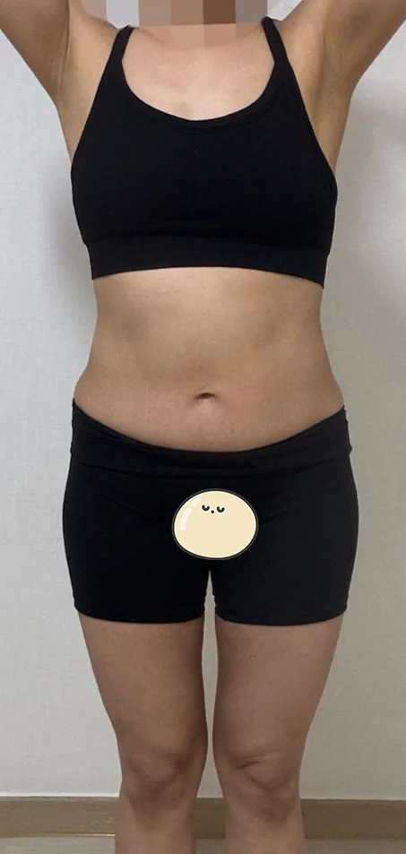 Fat grafting and liposuction, 3 months i - Hip Fat Grafting Before 2 - TheLINE Plastic Surgery