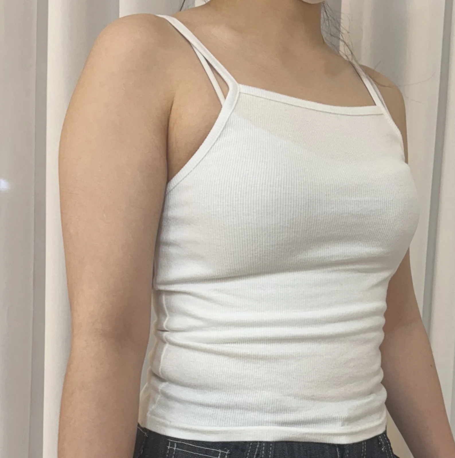 Arm liposuction review, so happy with it - Arm Liposuction surgery Before photo - TheLINE Plastic Surgery
