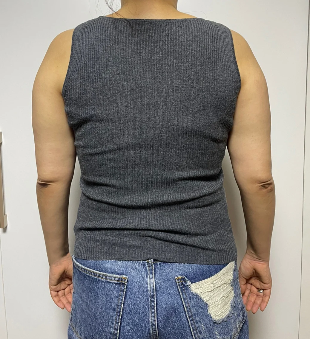 Stem cell arm liposuction review! - Arm Liposuction Before 2 - TheLINE Plastic Surgery