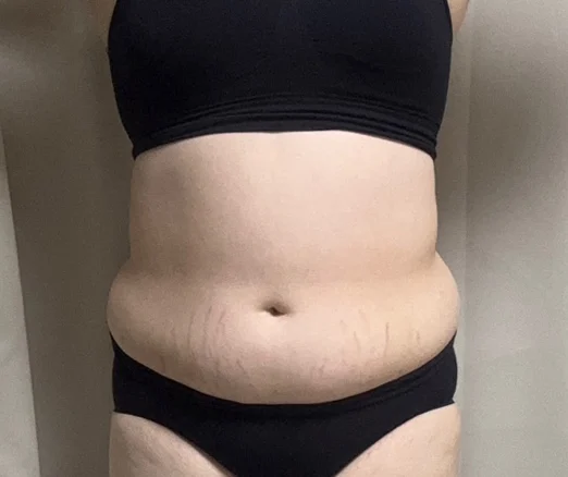 Upper body liposuction review! - Abdominal Liposuction (Upper Body) Before 2 - TheLINE Plastic Surgery