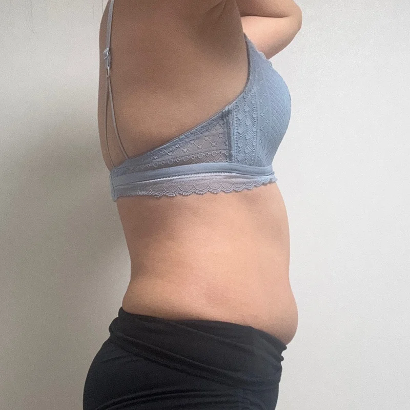 6 months after surgery with Dr. Yoongeun - Abdominal Liposuction (Upper Body) Before 2 - TheLINE Plastic Surgery